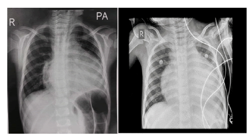 puljhr-5-5-Chest X-Ray